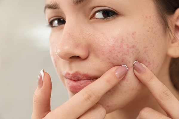 Treat Acne Naturally From Home without Side Effects